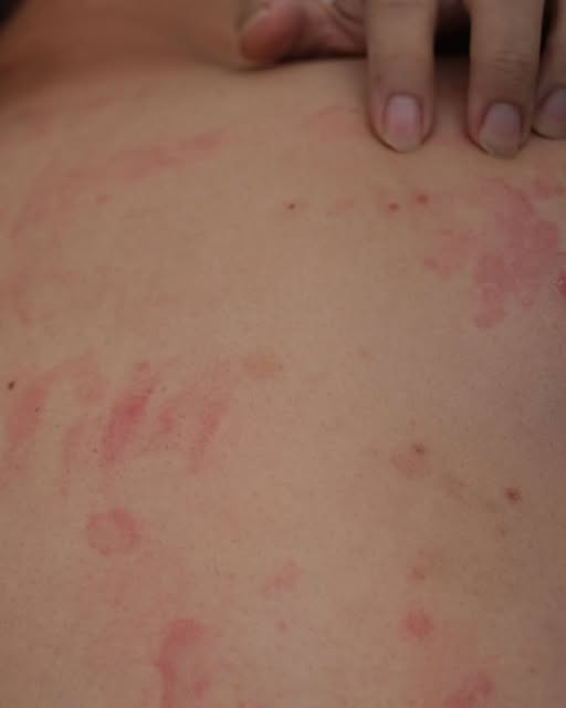 Semnal de alarmă de la medici! Mâncărimea poate fi primul indiciu al afecțiunii…